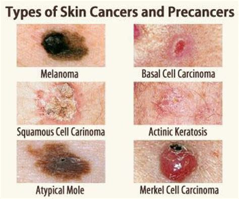 show me a picture of a mole|Skin Cancer Photos: What Skin Cancer & Precancerous ...